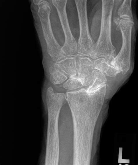 Slac Wrist Arthritis Raleigh Hand To Shoulder Center