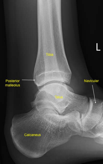 Ankle Fractures Treatment And Management Point Of Care