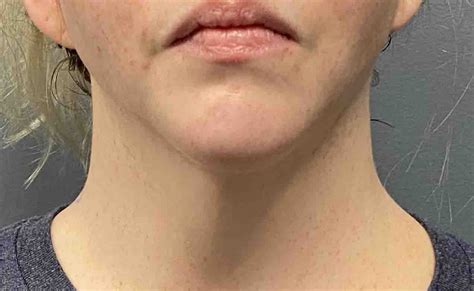 Female Webbed Neck Correction Front View Dr Barry Eppley Indianapolis