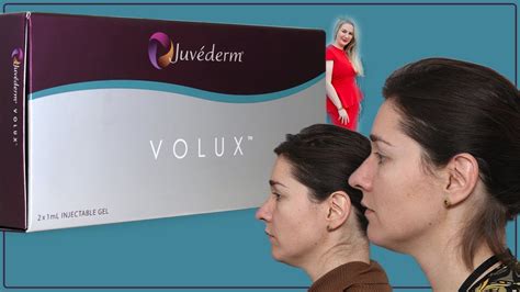 Chin And Jawline Filler Juvederm Volux With Before And After Pictures