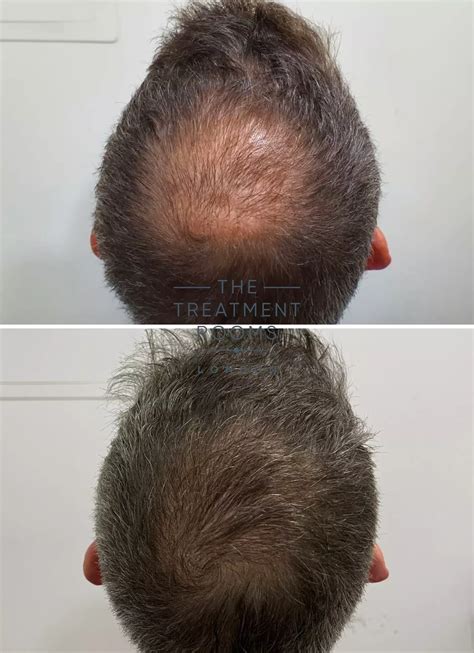 Fue Hair Transplant Result Grafts Treatment Rooms London