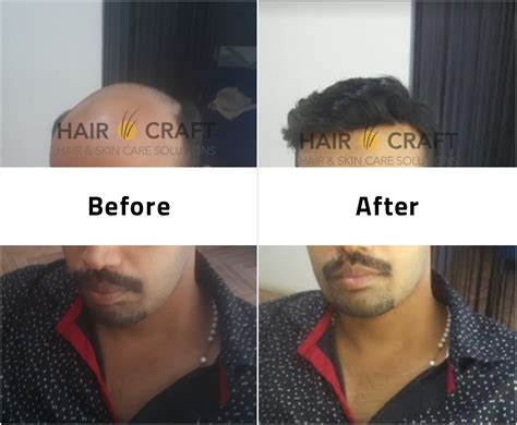 Hair Fixing Before After Photo Gallery Hairocraft