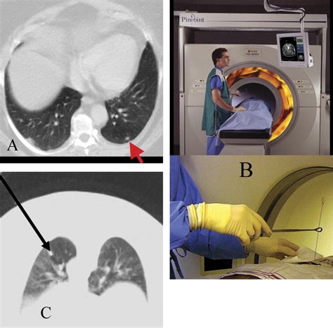 Identification Of Small Lung Nodules Technique Of Radiotracer Guided