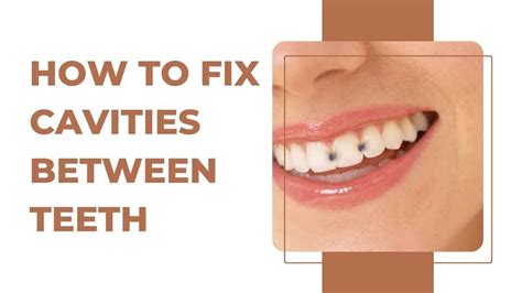 How To Fix Cavities Between Teeth A Comprehensive Guide In 2023