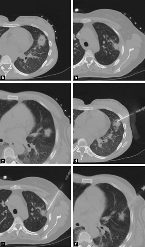 Figure 1 From Ct Guided Biopsies In Lung Infections In Patients With