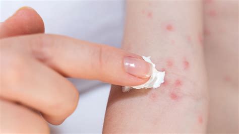 Treating An Allergic Skin Reaction Contact Dermatitis Goodrx