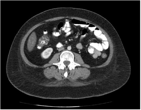 Abdominopelvic Ct Scan With Intravenous And Oral Contrast Agent