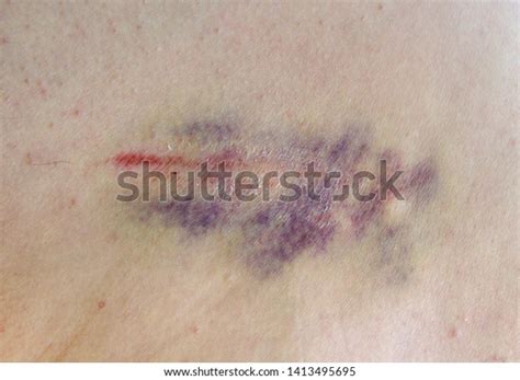 Hematoma Tissue After Bruise Contusion Characteristic Stock Photo Edit