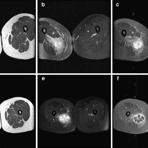 Radiographic Features Of An Evolving Soft Tissue Aneurysmal Bone Cyst