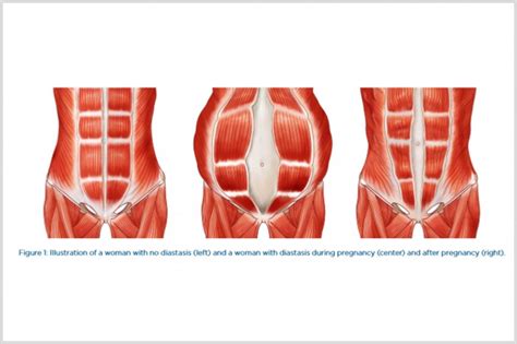 Maybe you would like to learn more about one of these? Diastasis Recti in Women - Emsculpt - Body Sculpt & Build ...