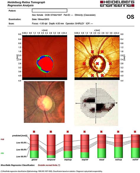 Figure From Changes On Confocal Scanning Laser Ophthalmoscopy With