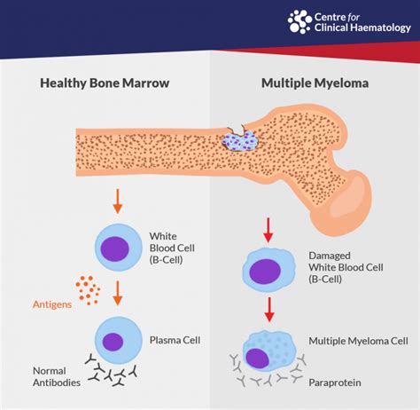 Myeloma Signs Diagnosis And Treatments In Singapore