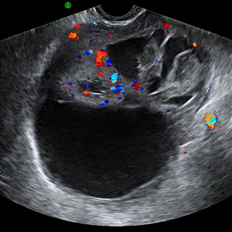 Ovarian Granulosa Cell Tumour Medical Ultrasound Obstetric