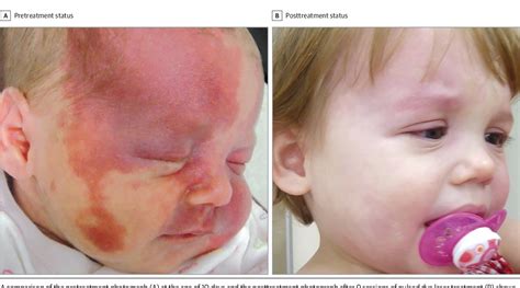Table 1 From Pulsed Dye Laser Treatment Of Port Wine Stains In Infancy