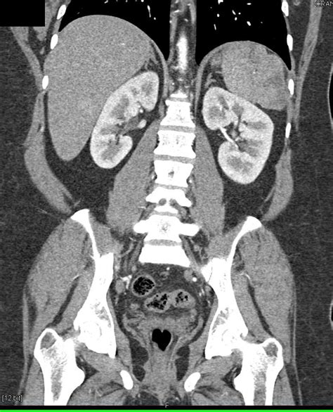 Acute Pyelonephritis Right Kidney Kidney Case Studies Ctisus Ct