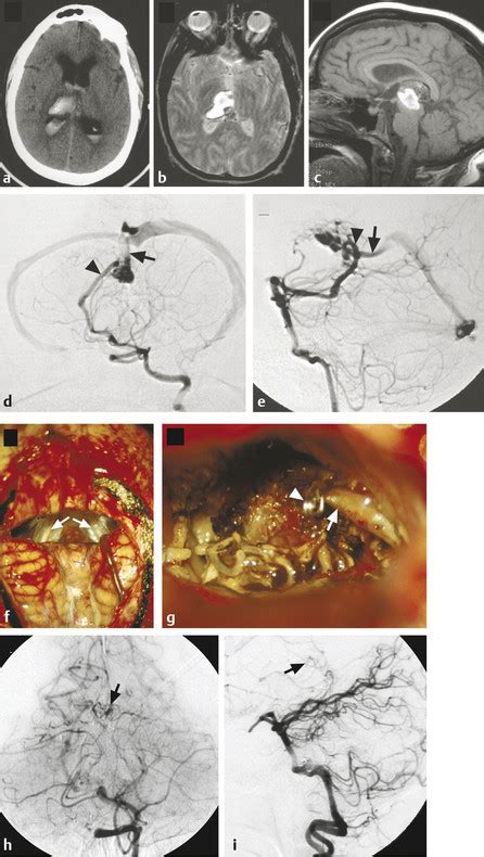 Arteriovenous Malformations Of The Basal Ganglia And Thalamus Neupsy Key