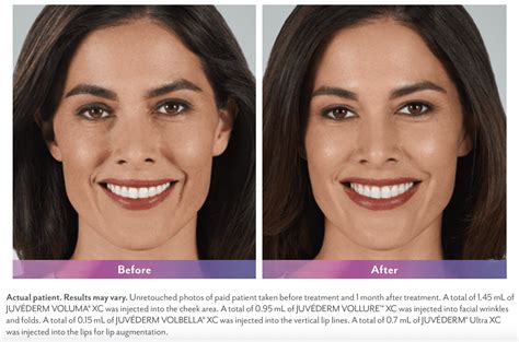 Fillers Cns Center Of Arizona And Medical Aesthetics