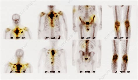 Bone Scan Showing Multiple Metastases Stock Image C0271195