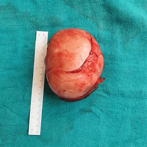 Cureus A Giant Epidermal Cyst In The Gluteal Region A Case Report
