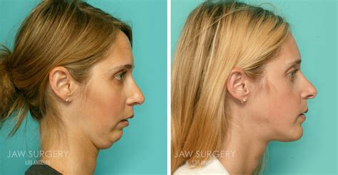 Broken Jaw Surgery Before And After Jaw Surgery Before And After Photos