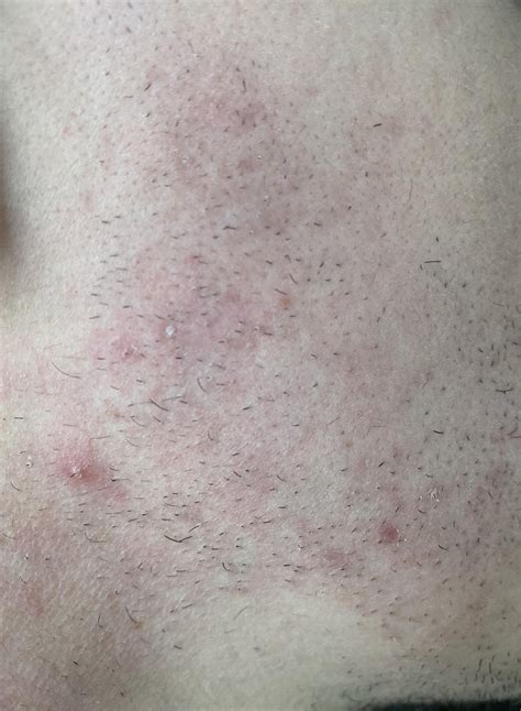 Fungal Acne Folliculitis What Is This And How Do I Fix It Please