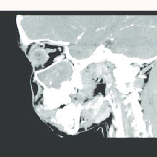 Sagittal CT Revealed A Large Expansile Mass Occupying The Whole Left