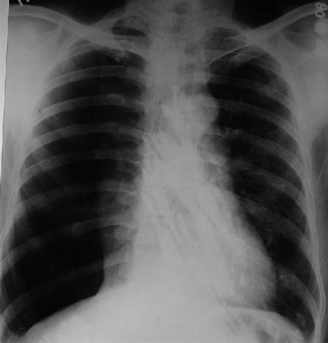 Chest X Ray Lateral View Showing Pneumothorax Download Scientific Vrogue