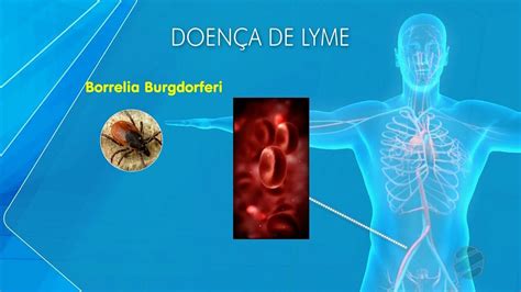 Doença De Lyme Entenda As Causas E Sintomas Da Doença Que Afastou