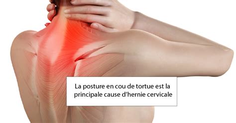 Hernie Cervicale Symptomes Causes Traitement
