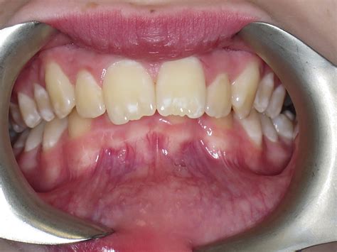 Protruding Teeth Teeth In Line