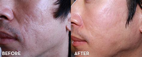 Acne Scar Treatment Results Before And After Cherry Creek