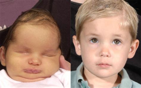 Craniosynostosis Before And After Pictures Dallas Plano Tx