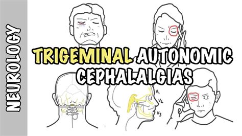 Severe Headaches Understanding Trigeminal Autonomic Cephalgias