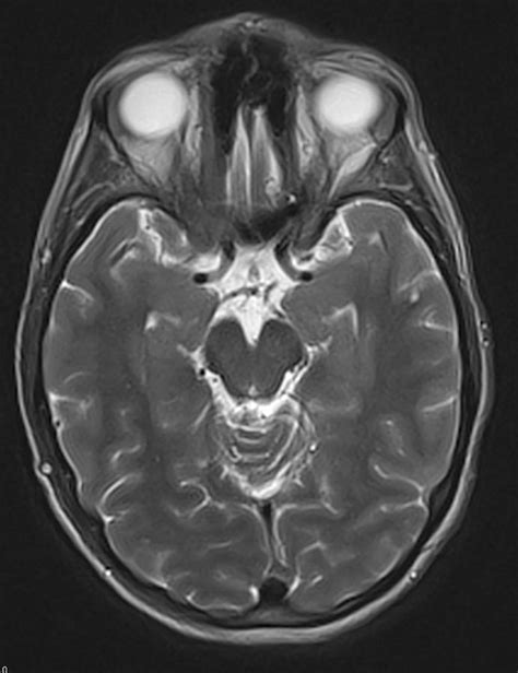 Brain Cancer Treated Mri Photograph By Steven Needell