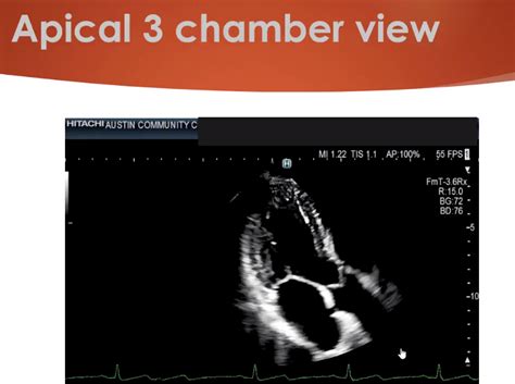 Apical 3 Chamber View Diagram Quizlet