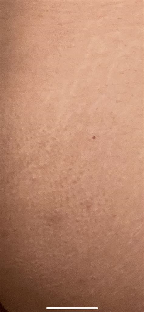 My Butt Has Had Bumps For Years I Had Folliculitis And My Derm
