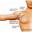 Shoulder Neck Pain Pinched Nerve Cause In 