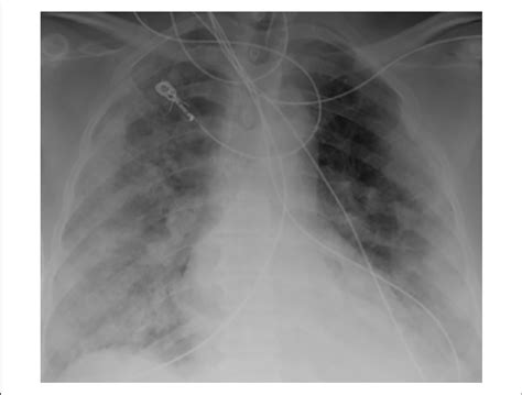 Chest X Ray Showing Mild To Moderate Pulmonary Venous Congestion Hazy