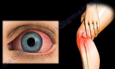 Maybe you would like to learn more about one of these? Reiter's Syndrome. Reactive Arthritis | by Nabil Ebraheim ...