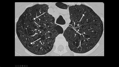 CT Patterns Of Lung Disease Dr Jannette Collins MRI Online Noon