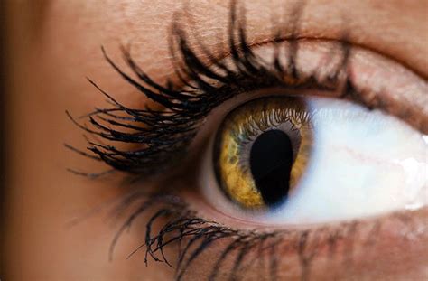 Cat Eye Syndrome All About Vision