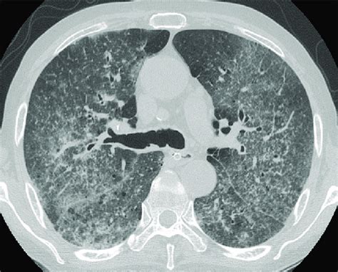 Follow Up Chest Ct Showing Increased Number Of Micronodules And Diffuse