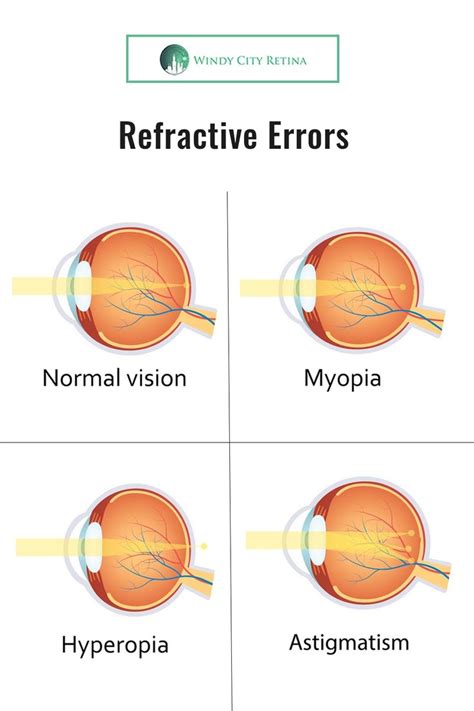 Overview Of Refractive Error Eye Disorders Appointments Optician