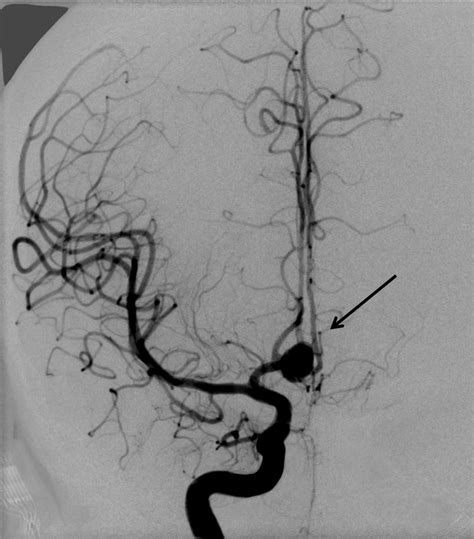 Think of a weak spot in a balloon and how. endovascular.es