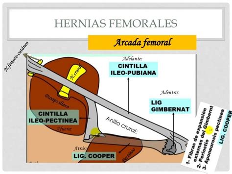 Hernias Abdominales Hernia Femoral Hernia Inguinal