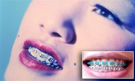 Fake Braces Trend Is A New Status Symbol For Asian Teenagers But Could They Kill Wearers