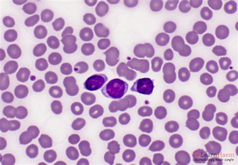 B Prolymphocytic Leukaemia Learnhaem Haematology Made Simple