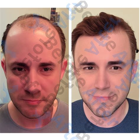 Hair Transplant Before And After Result 27 Before And After Images