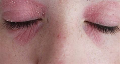 How Treat Dryness Around The Eyes Effectively Health Cautions