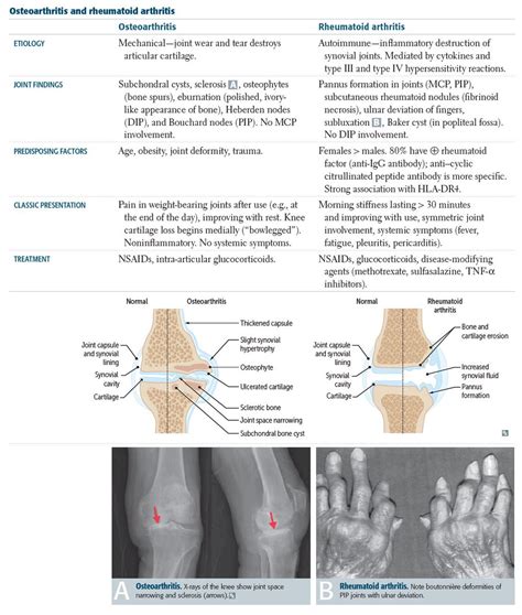 Comparing Osteoarthritis And Rheumatoid Arthritis Osteoarthritis
